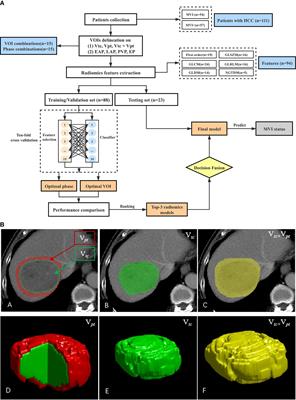 Prediction of Microvascular Invasion in Hepatocellular Carcinoma With a Multi-Disciplinary Team-Like Radiomics Fusion Model on Dynamic Contrast-Enhanced Computed Tomography